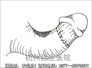 阴茎弯曲